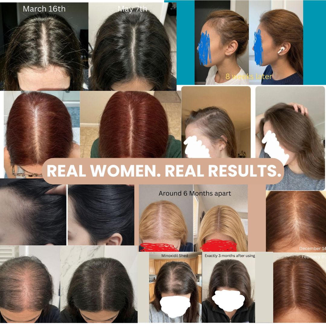 SheFlourish | Myo & D-Chiro Inositol | The Only Formula Designed To Fix The Real Root Cause Behind PCOS  Hair Loss